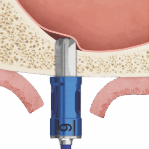 Inclined Sinus Floor