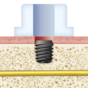 5mm Ex. Short Implant