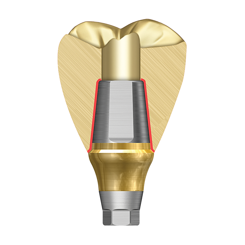 Screw-cement retained