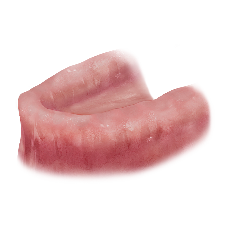 Full-Arch / Overdenture